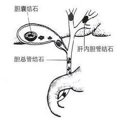鸡内金治疗胆结石偏方讲解...