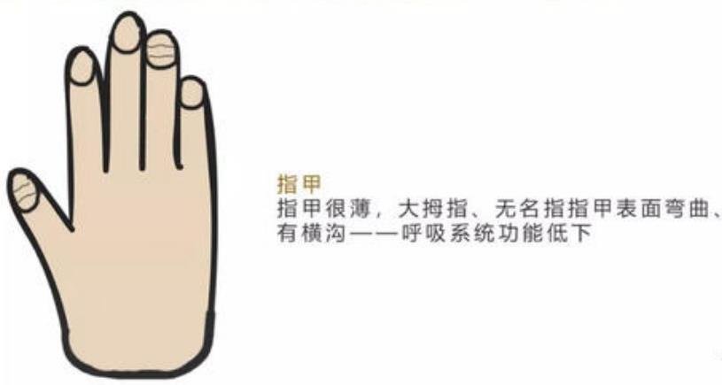 博氏线（指甲上出现横沟）...