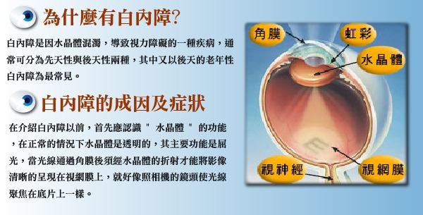 白内障