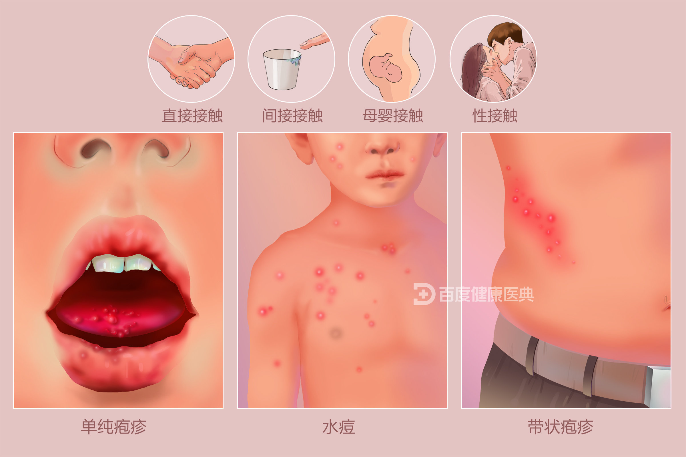 疱疹是因为什么原因引起的...