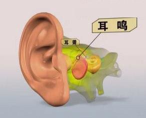 耳鸣怎么治疗效果好？